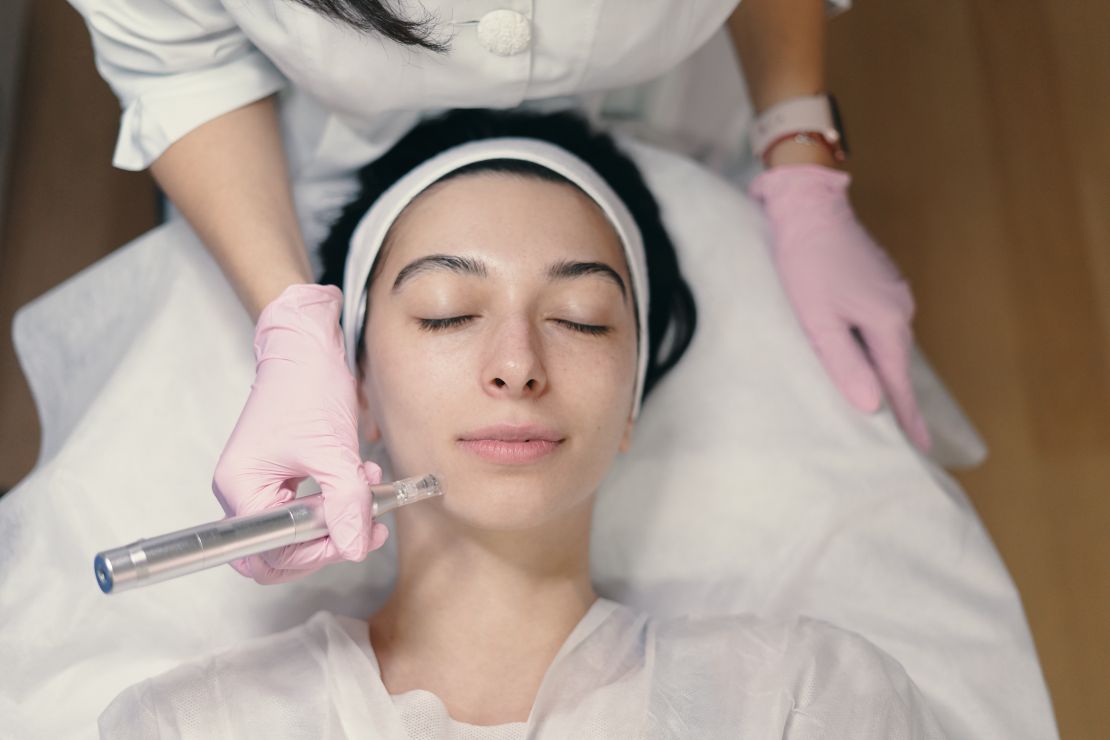 women getting microneedling done on her face